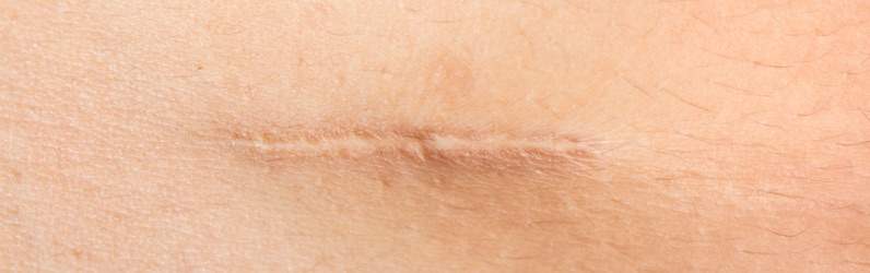 Example of a normal scar: These scars are flat and pale and will gradually fade over time.